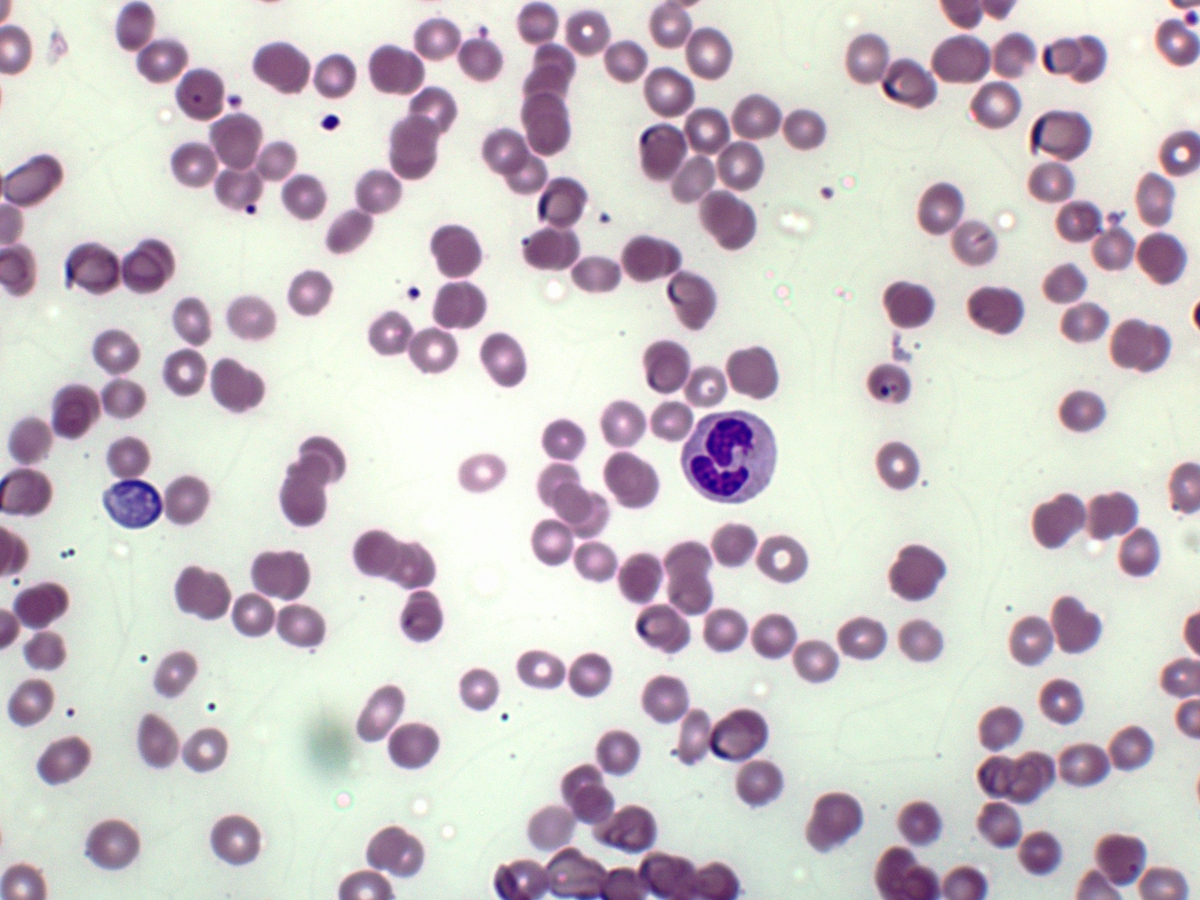 Pelger Huet like cell in PBS
